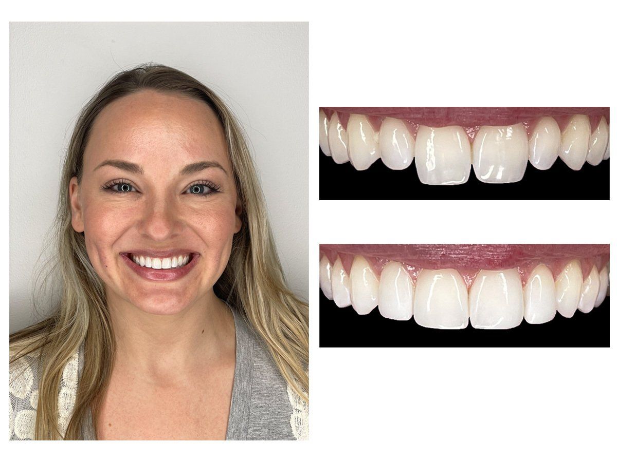 Cosmetic Composite Bonding 17