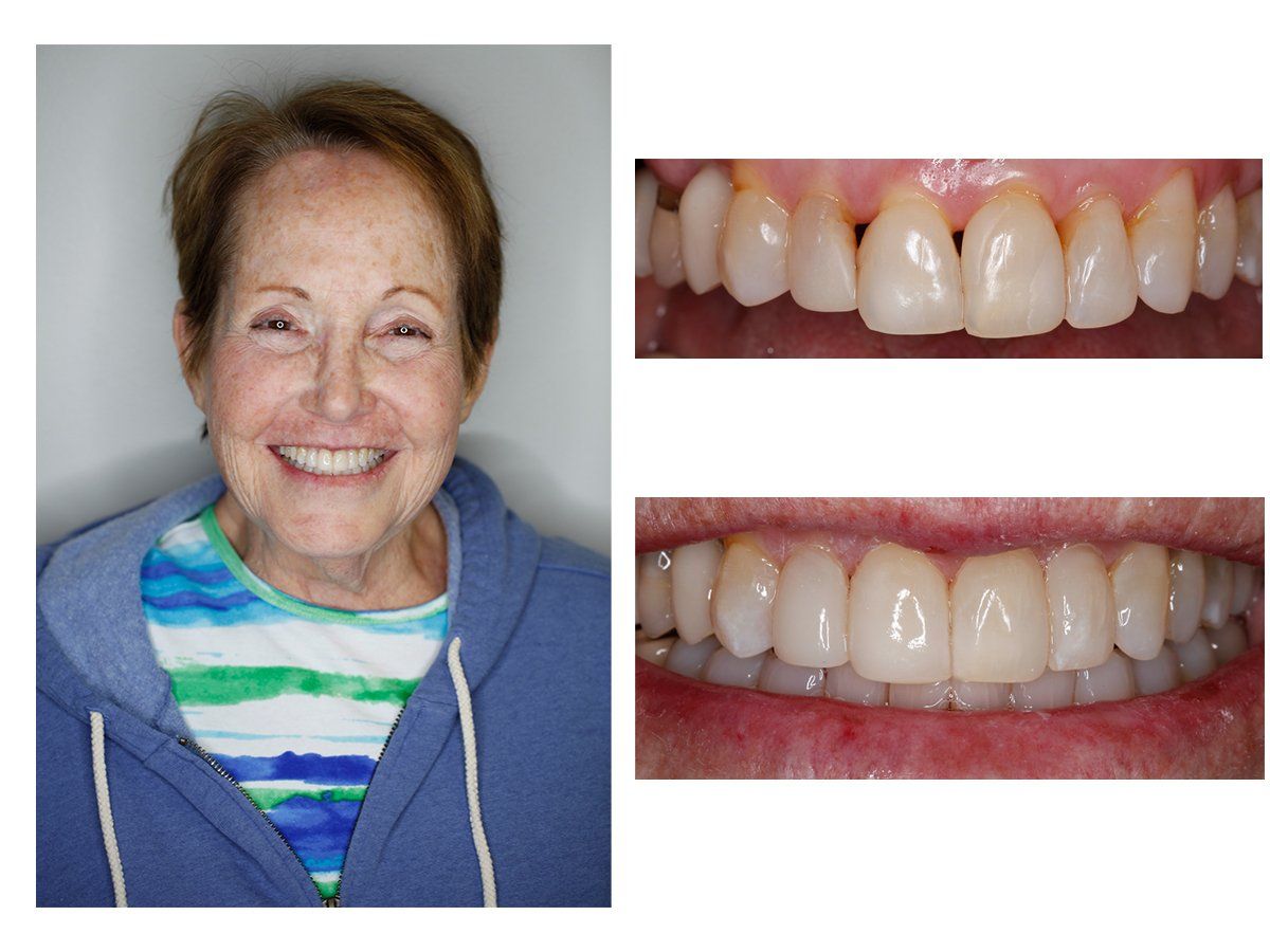 Cosmetic Composite Bonding 13