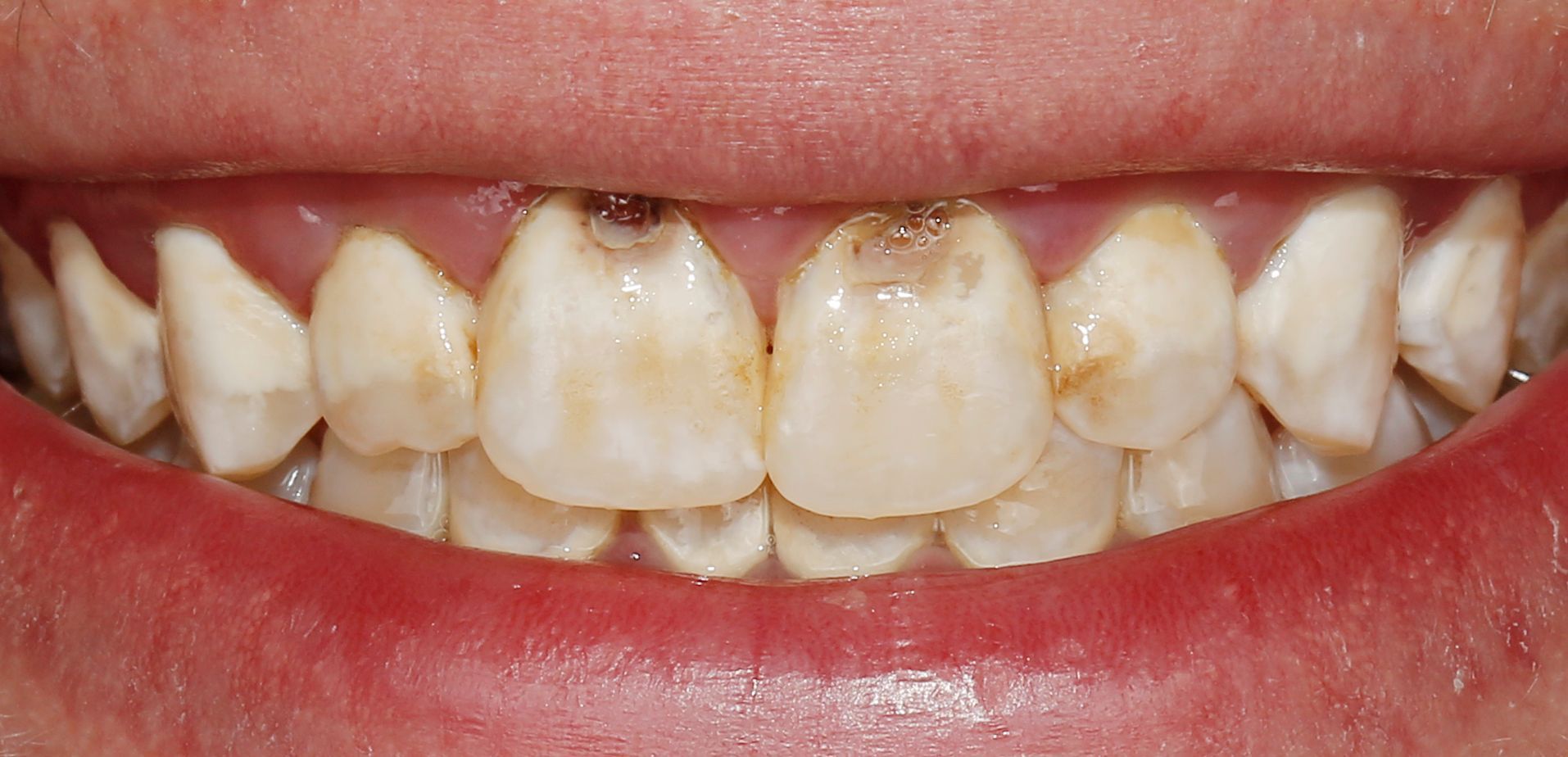 White Spots caused by Orthodontic Decalcification – Early enamel breakdown around braces due to plaque and acid
