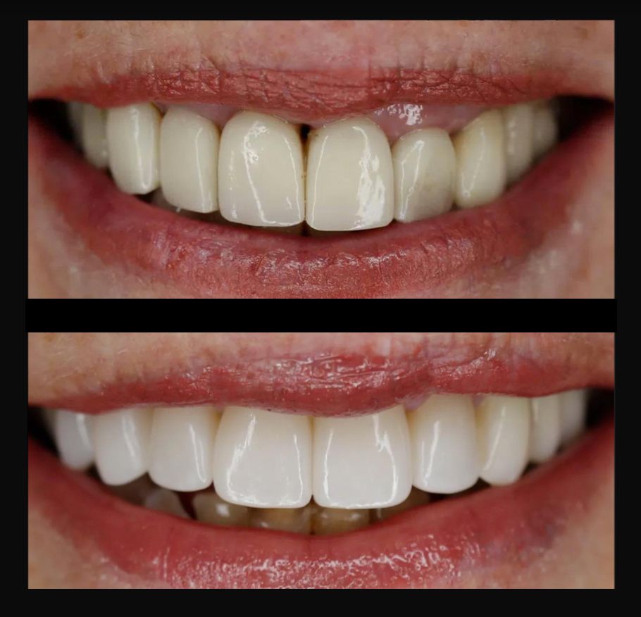 A before and after picture of a woman 's teeth