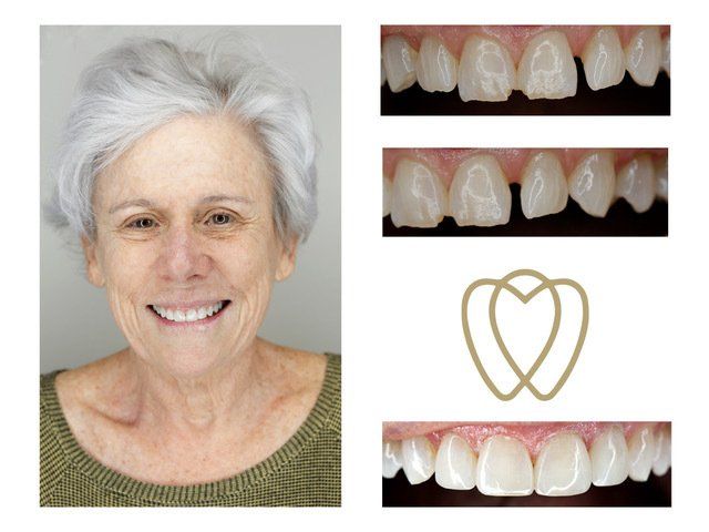 Cosmetic Composite Bonding 22