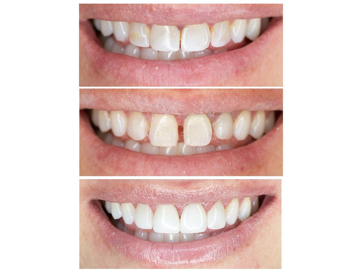 Cosmetic Composite Bonding 14