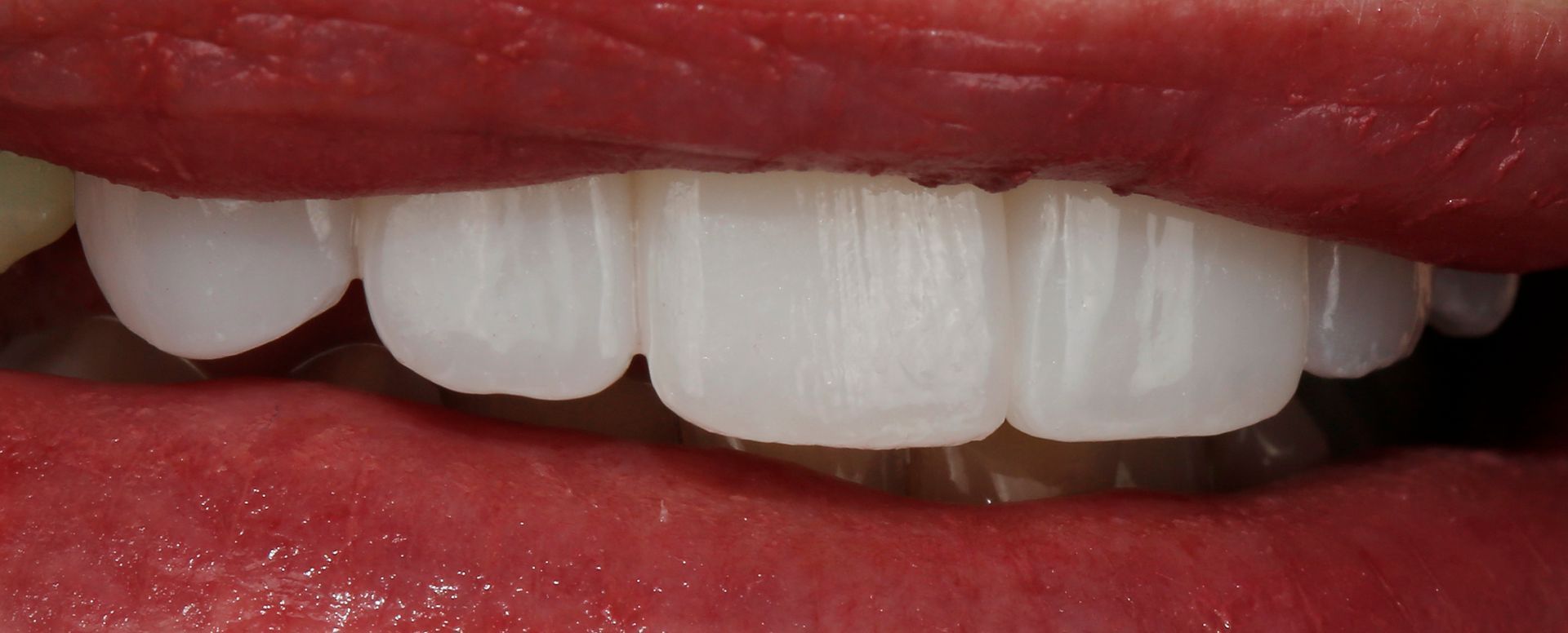 dental veneers