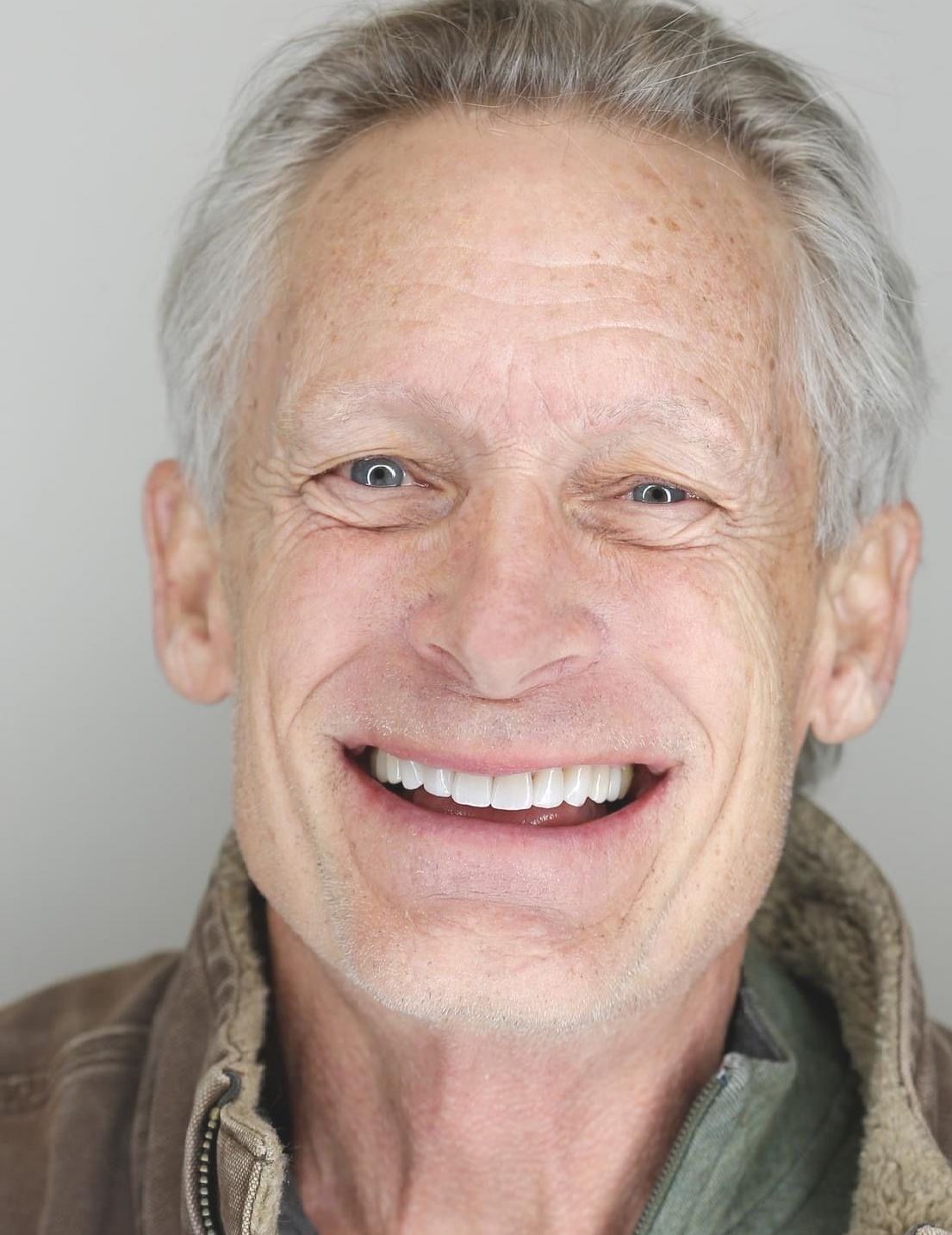 crowns and veneers Denver