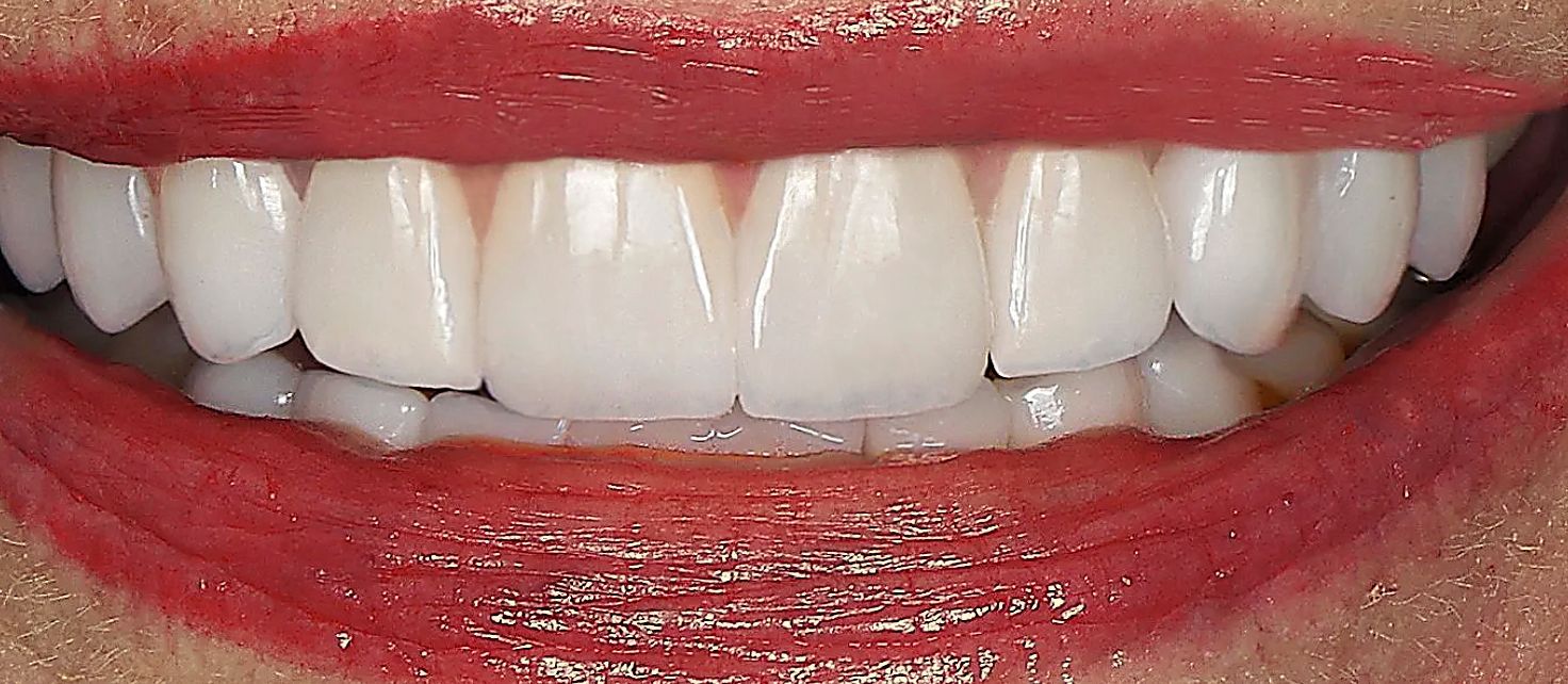 veneers