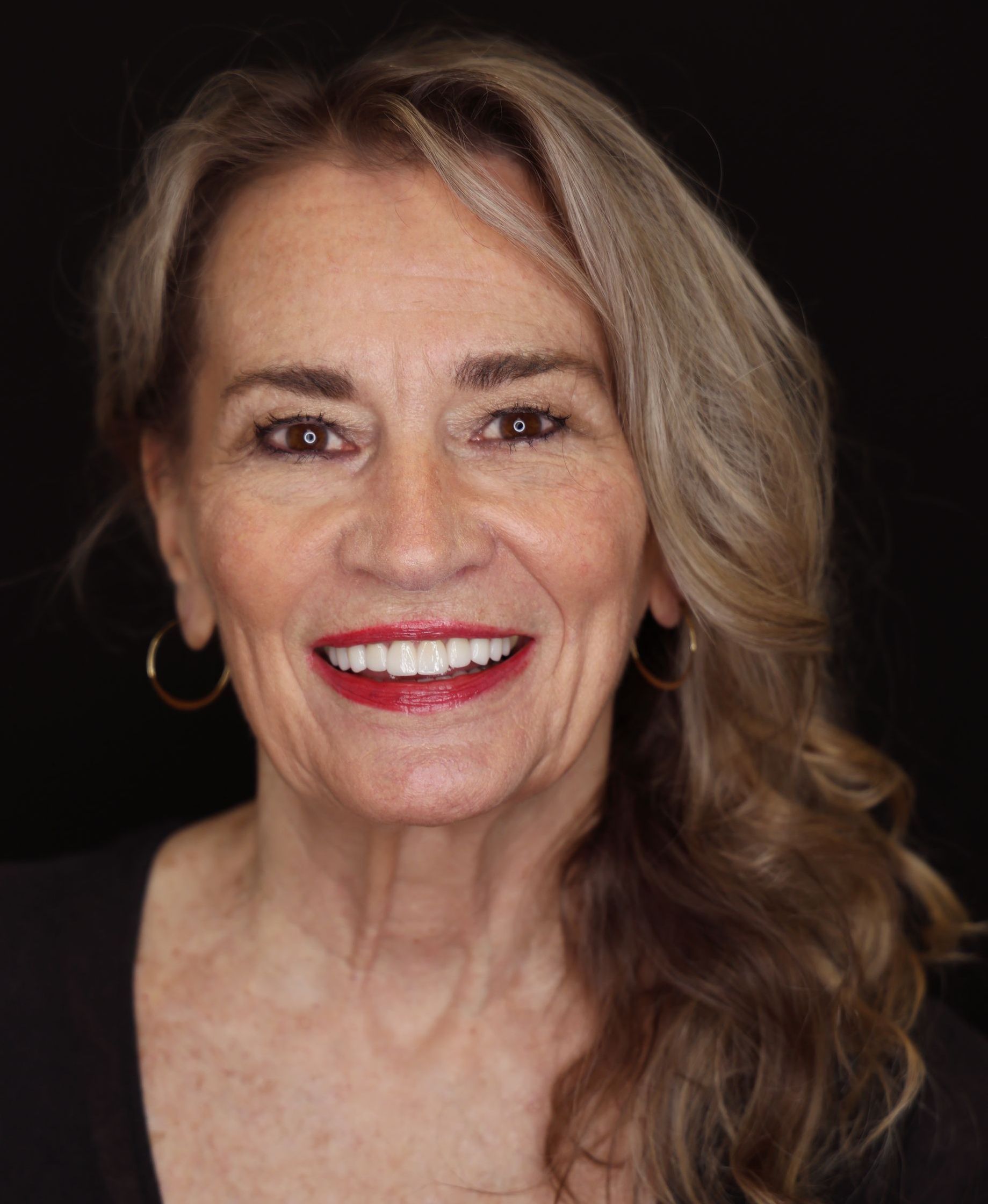 Beautiful result of veneers and porcelain restorations to fix broken teeth