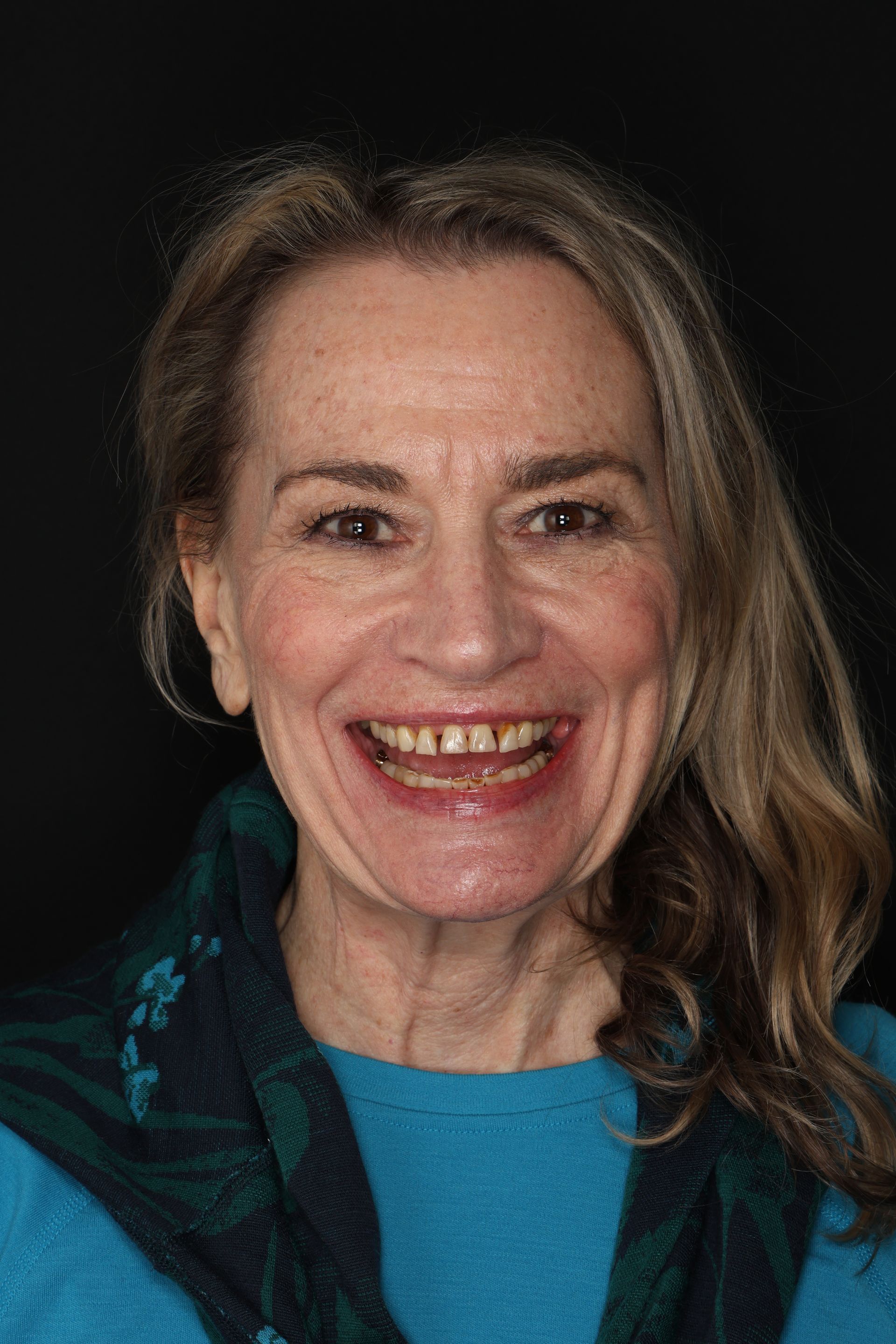 Woman with worn, stained, broken teeth in need of a full muth rehab denver