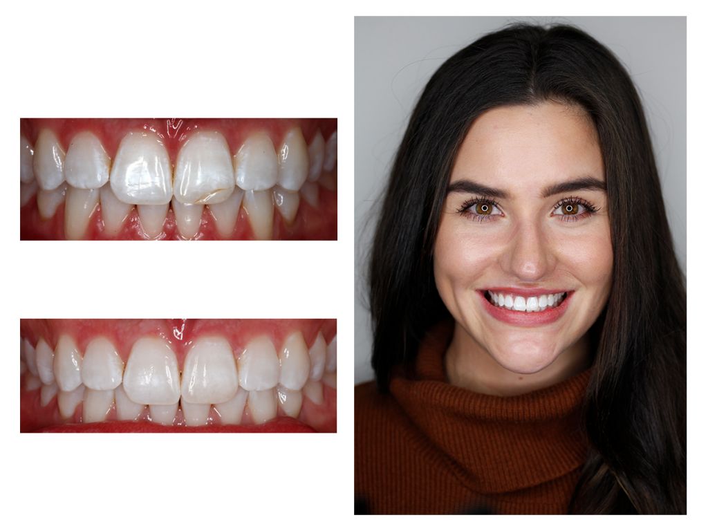 Cosmetic Composite Bonding 29