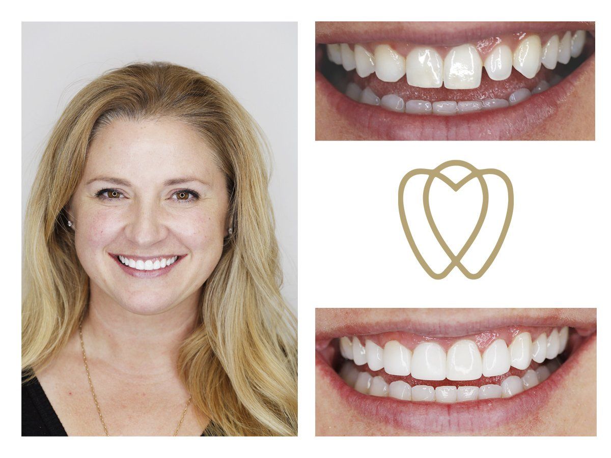 Cosmetic Composite Bonding 6