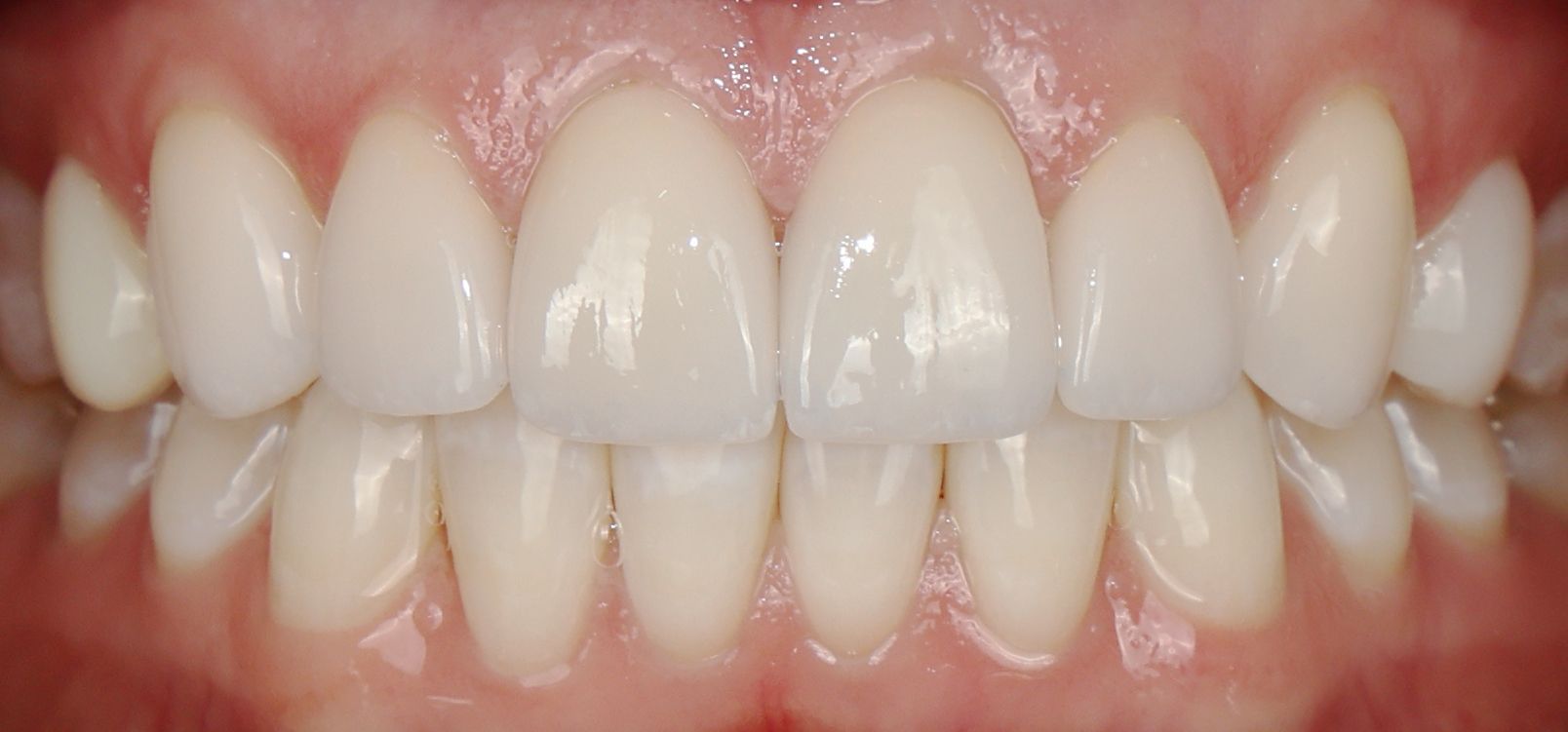 Porcelain veneers to fix stained discolored teeth from fluorosis