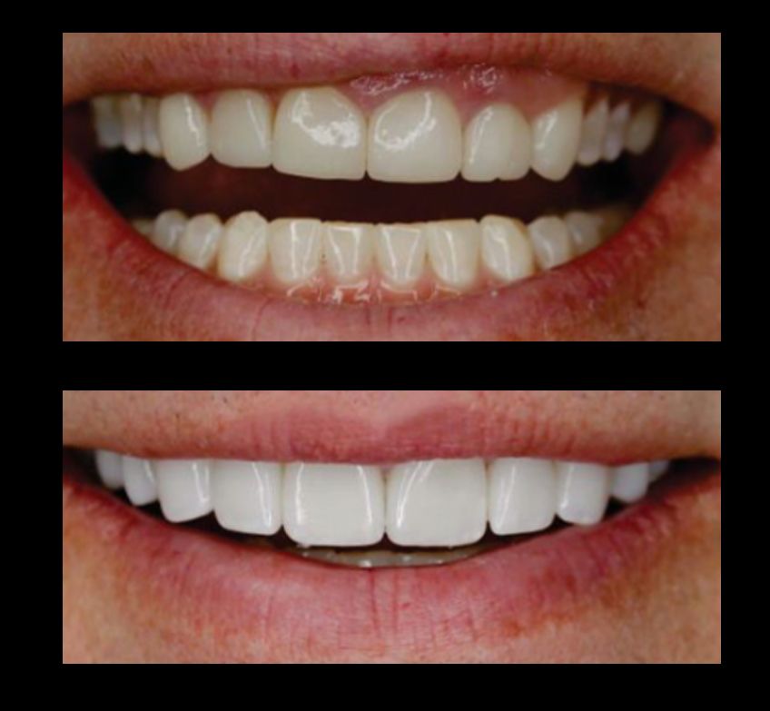 A before and after picture of a porcelain veneers in Colorado