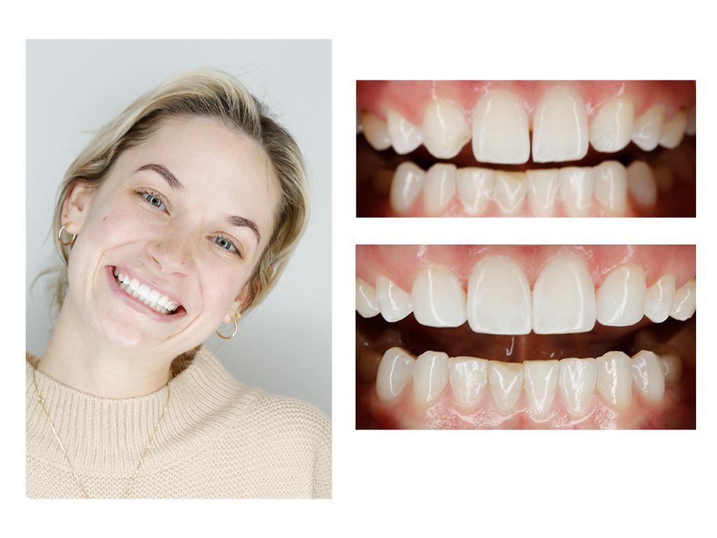 Cosmetic Composite Bonding 18