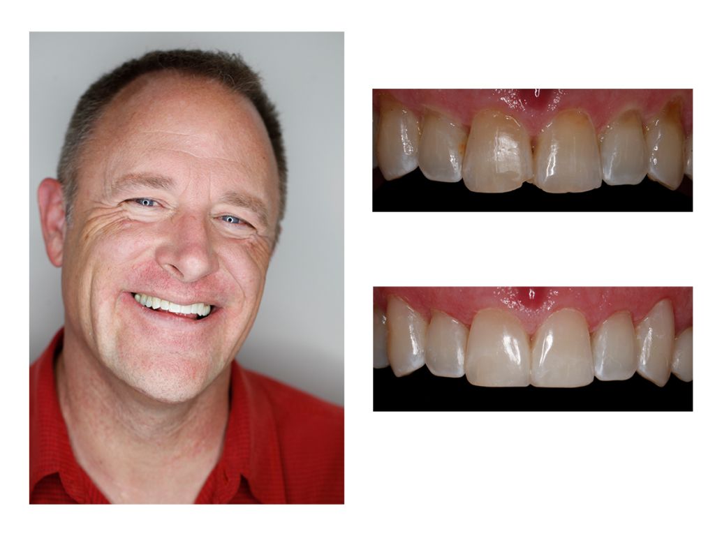 Cosmetic Composite Bonding 32