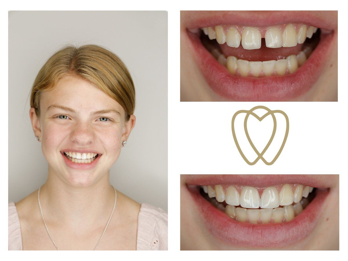 Cosmetic Composite Bonding 4