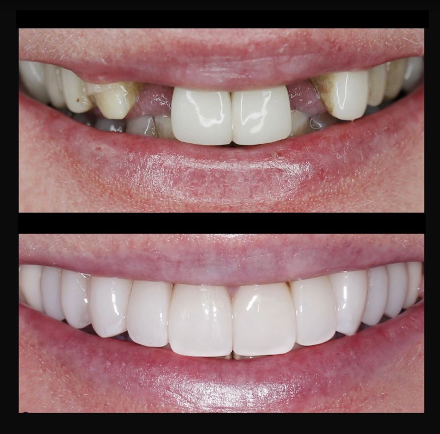 white full smile, denver