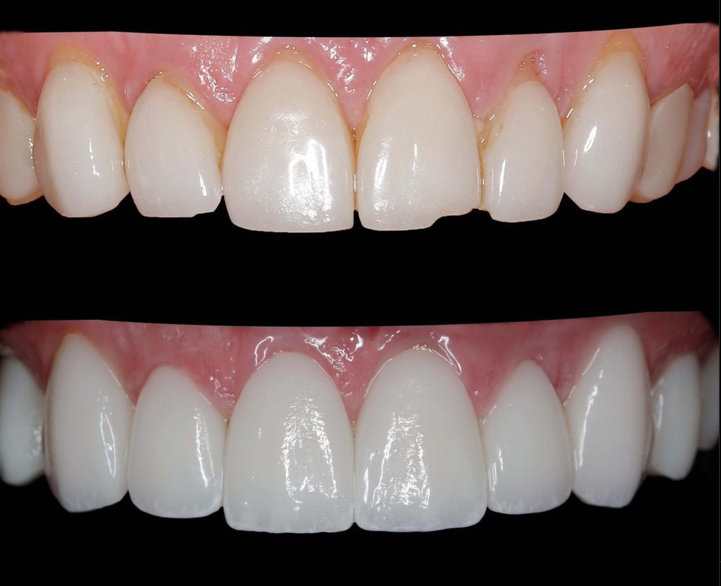 Chipped veneers need replacement