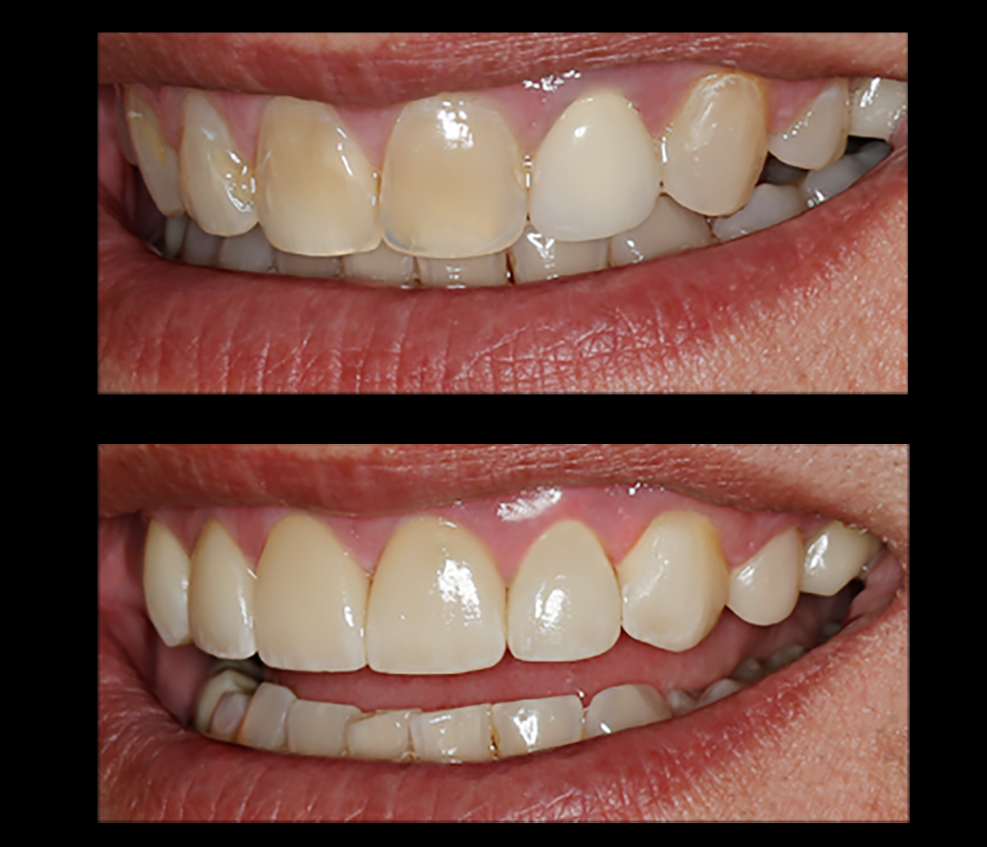 natural veneers in denver