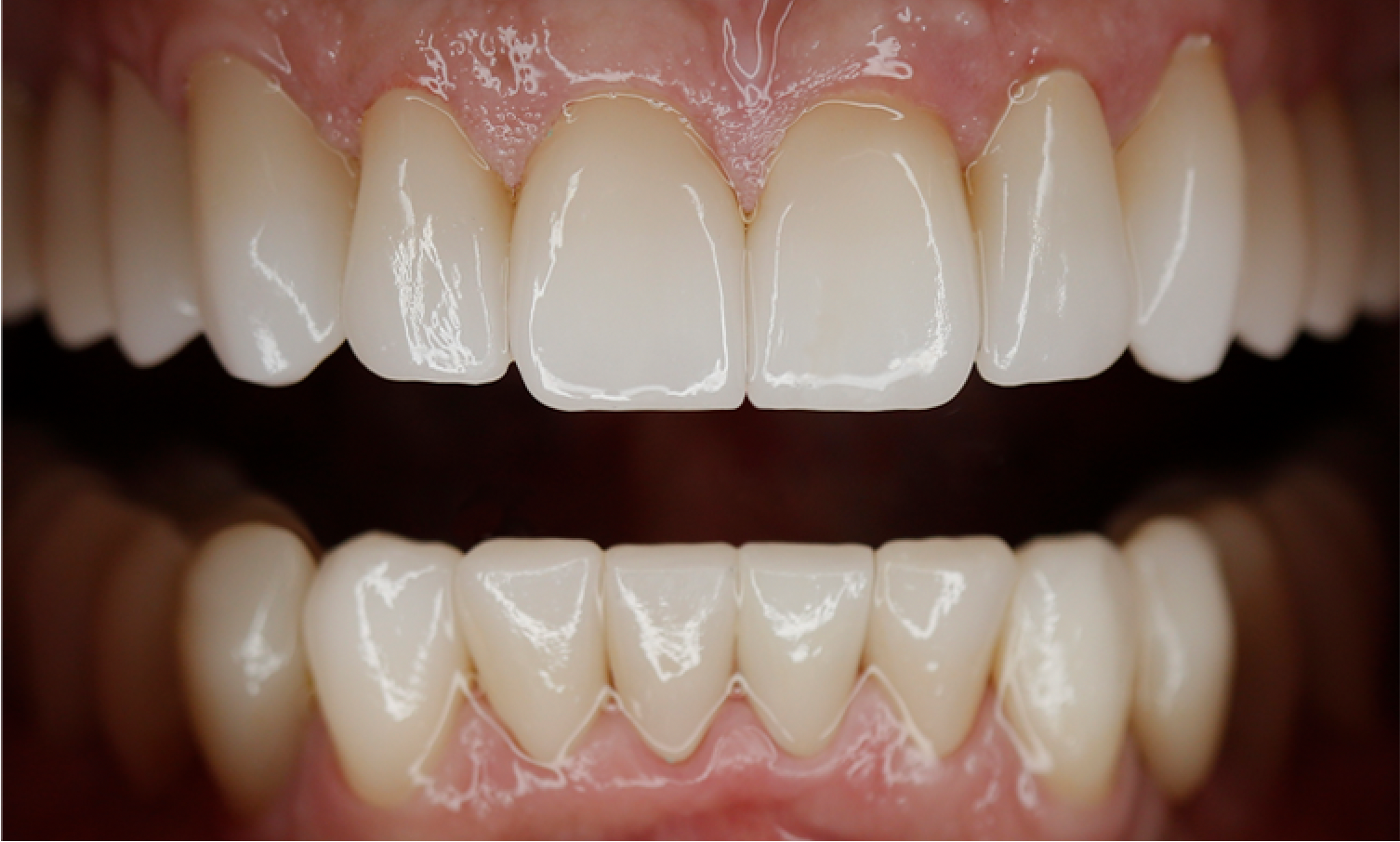 full mouth rehabilitation to restore aged, worn and broken teeth in denver tech center