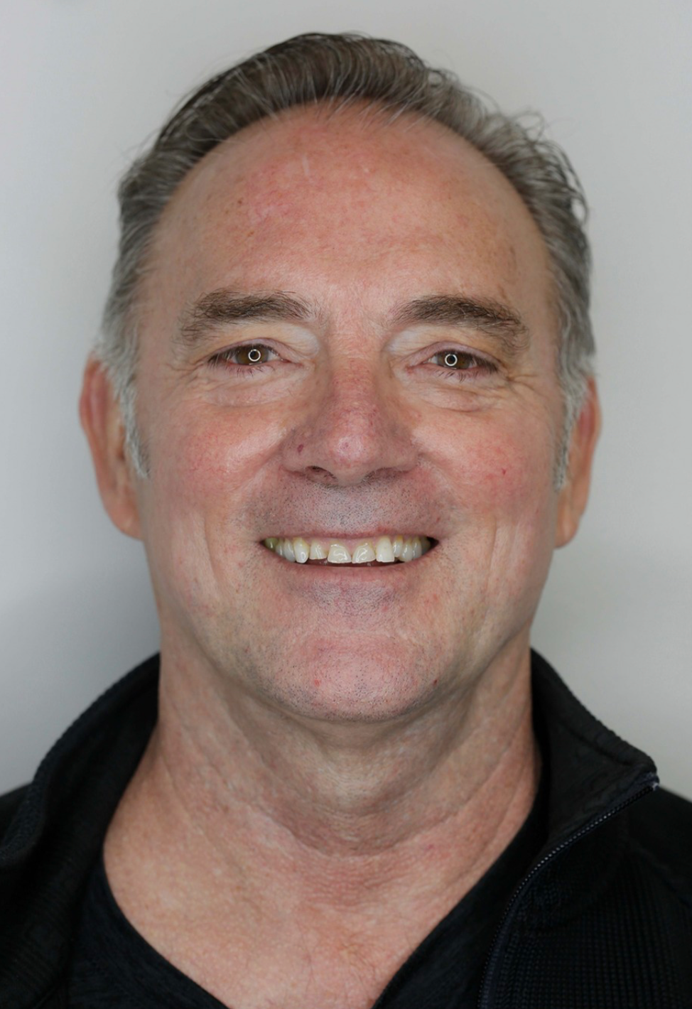 before photo of broken teeth that need crowns