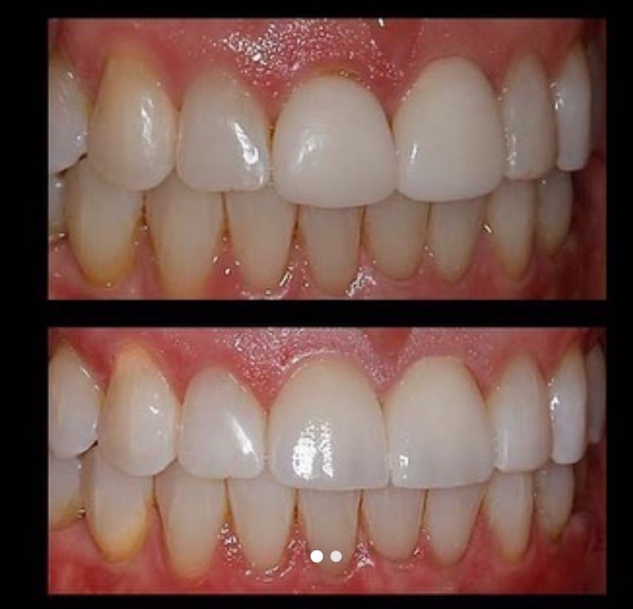 natural looking veneers denver