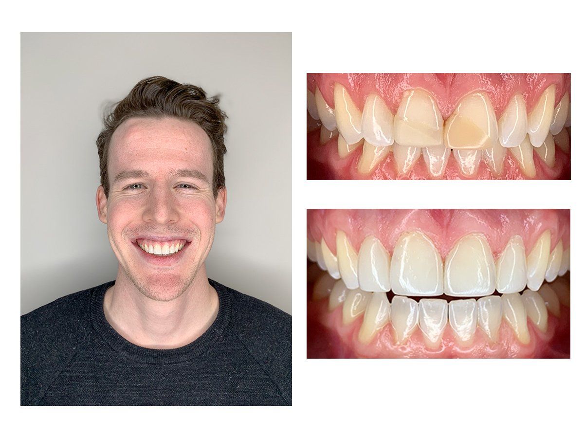 Cosmetic Composite Bonding 9