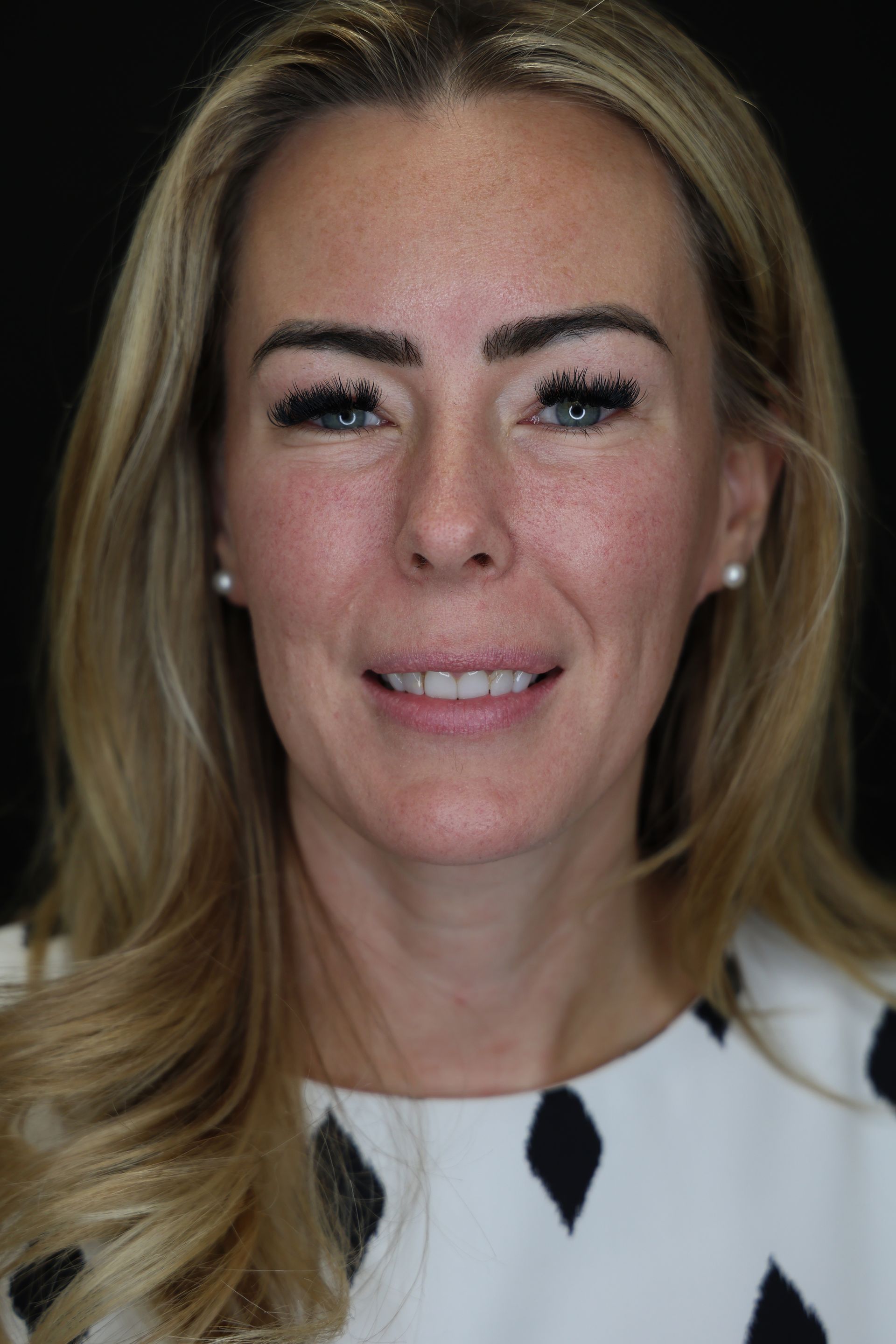 Woman with worn, stained, broken teeth in need of a full muth rehab denver