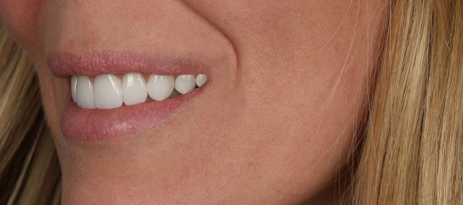 perfect white natural smile veneers