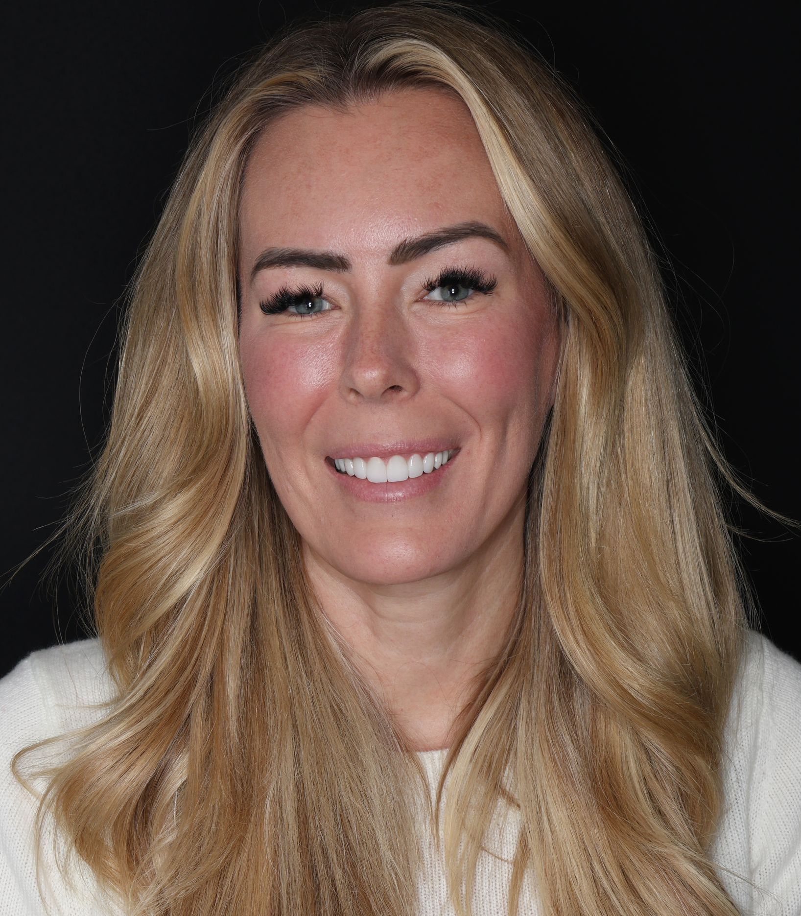 Beautiful result of veneers and porcelain restorations to fix broken teeth