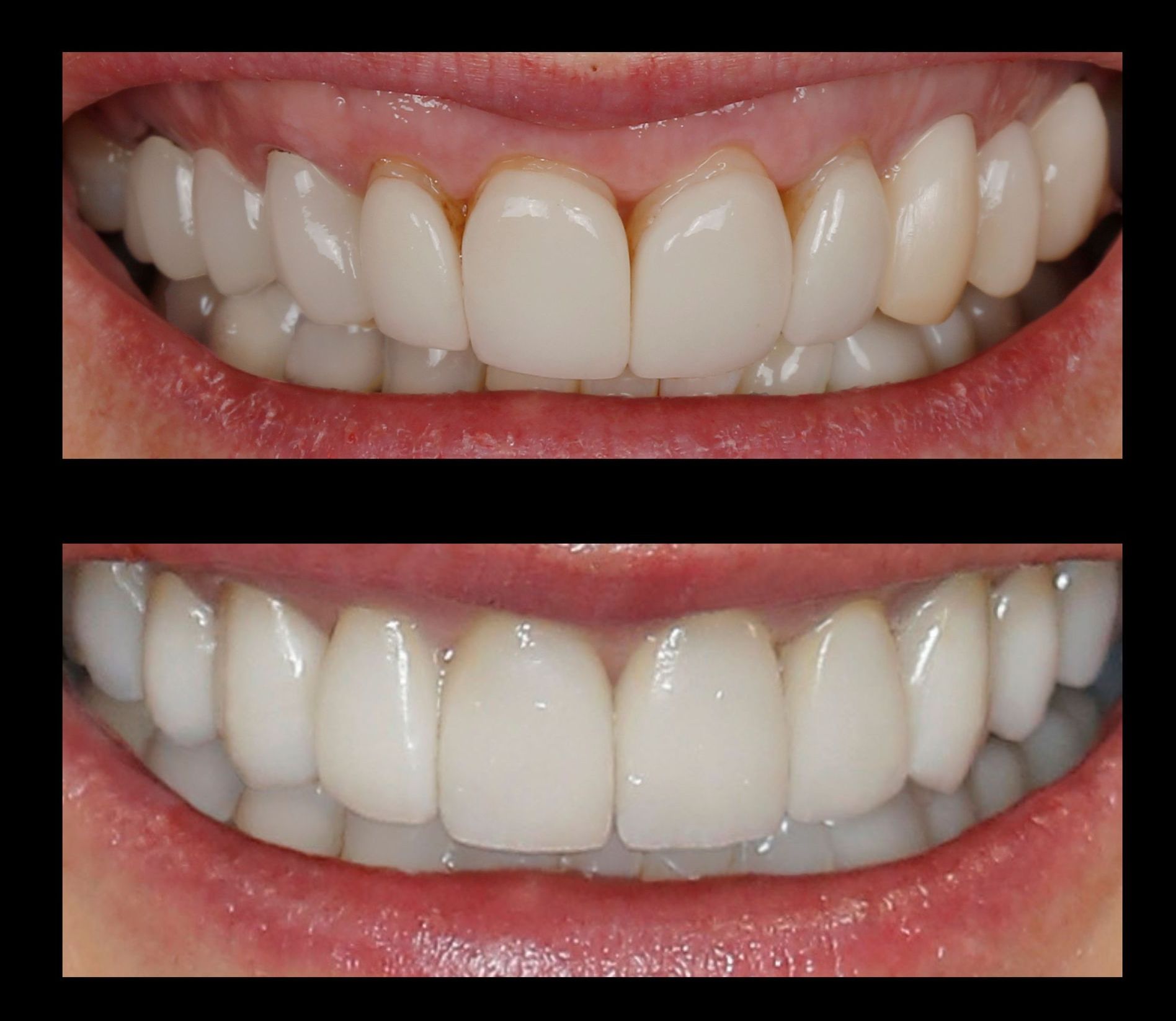 replacement veneers denver 
