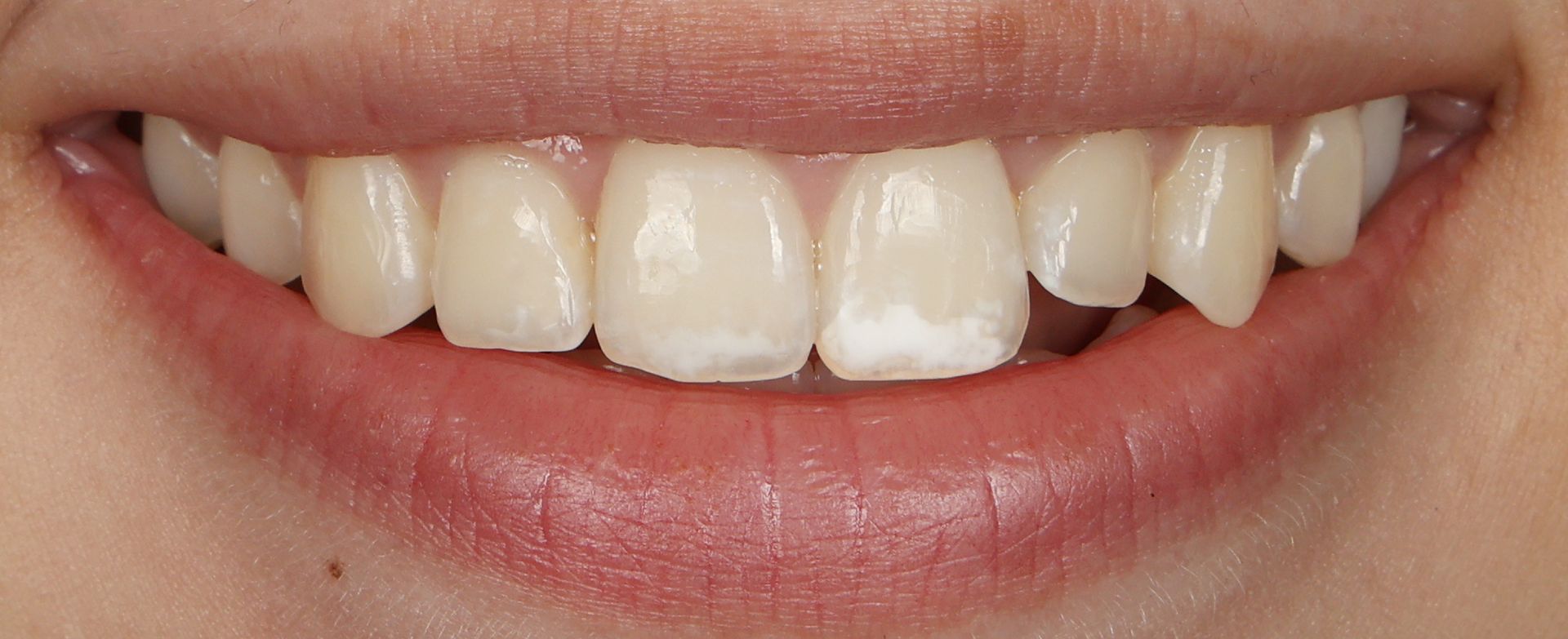 Uneven tooth length and white spots in denver