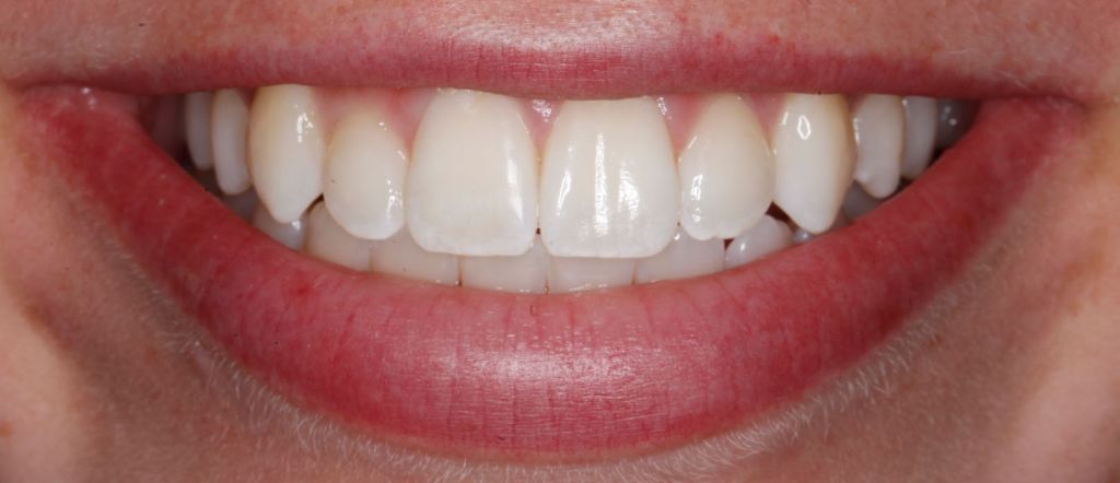 Whiten or Bleach Discolored Tooth smile Greenwood Village cosmetic dentist