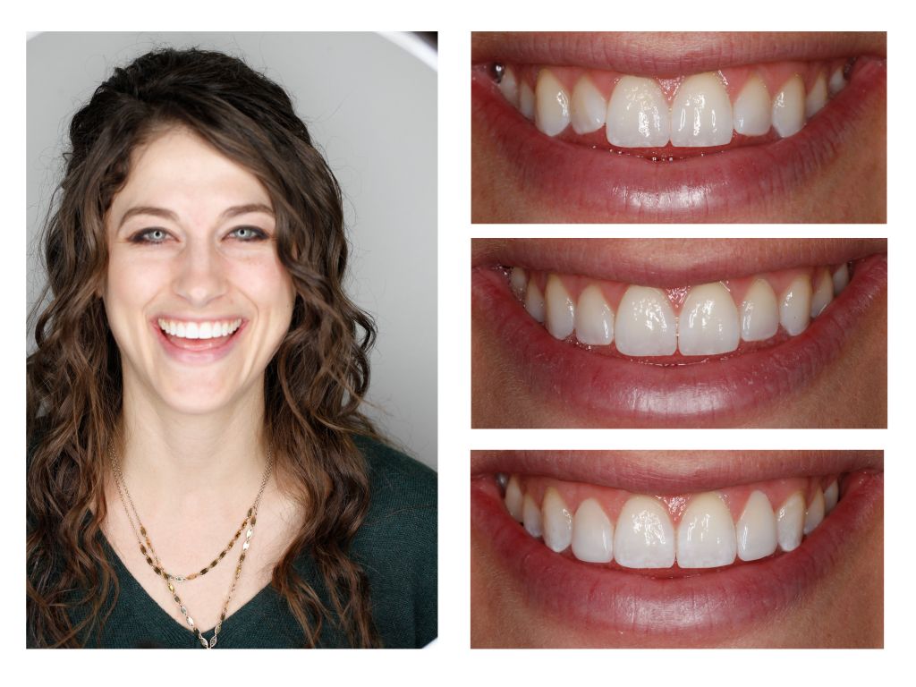 Cosmetic Composite Bonding 21