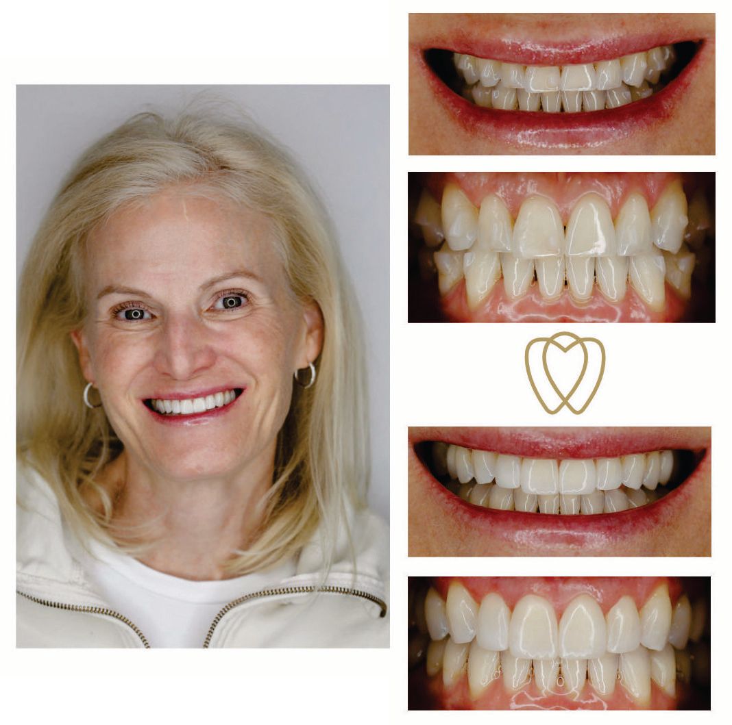 A woman is smiling next to a picture of her teeth