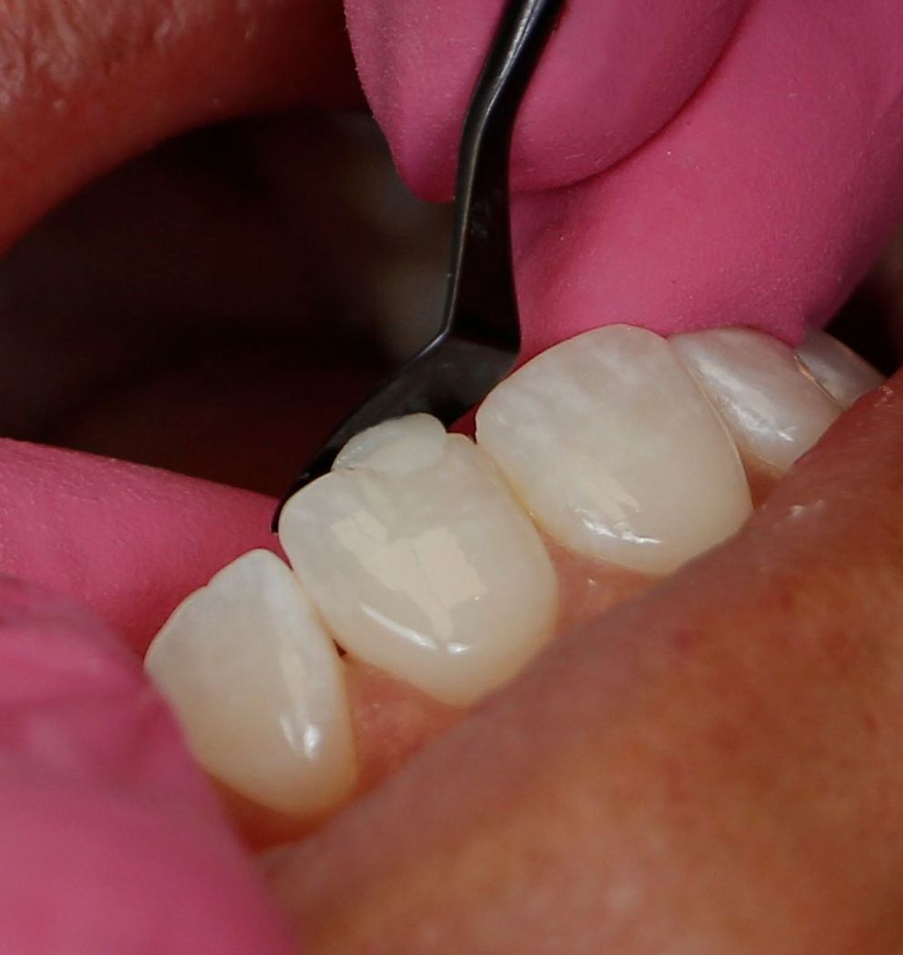 dr kittell doing dental bonding 