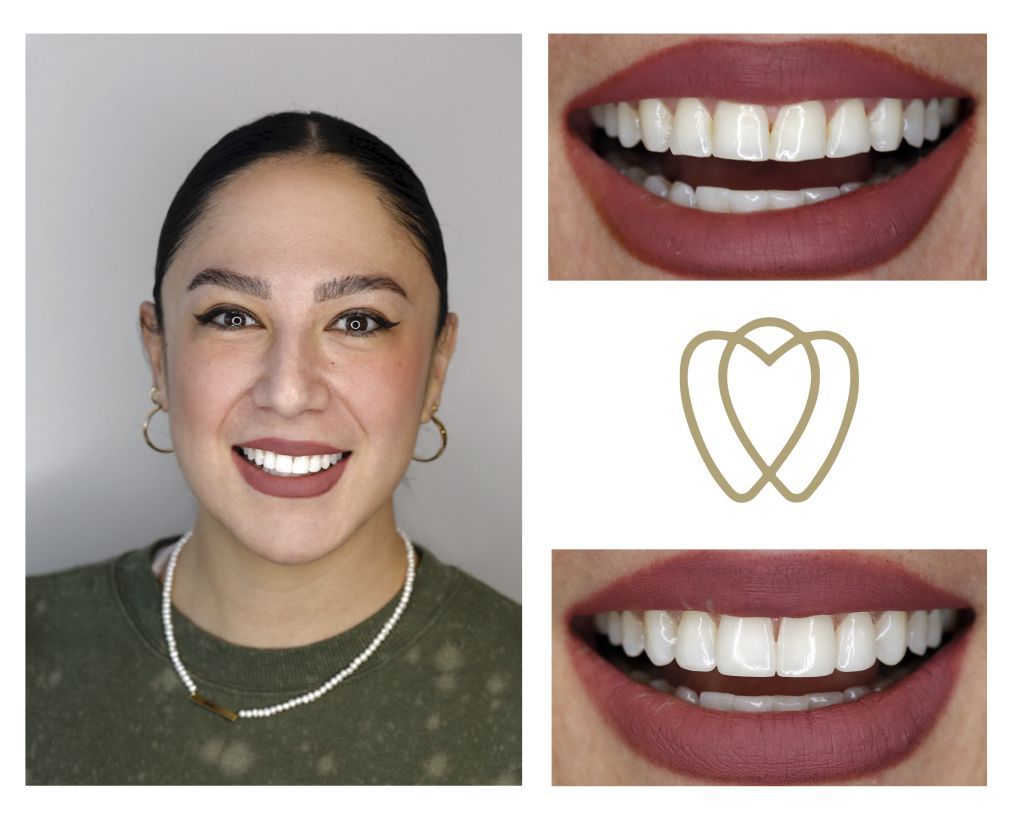 Cosmetic Composite Bonding 19