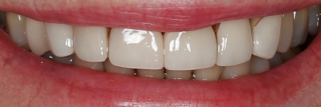 before photo of old veneers that need crowns