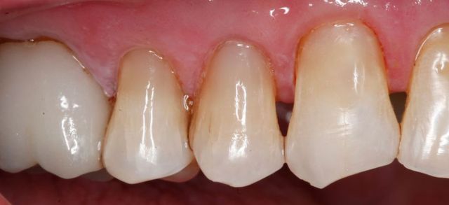 Dental Bonding  Smith and Van Lierop Dentistry