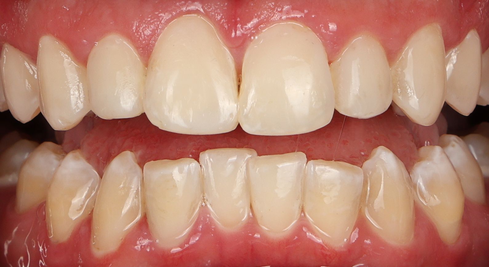 Composite Bonding to remove white spots and cavities for a seamless smile