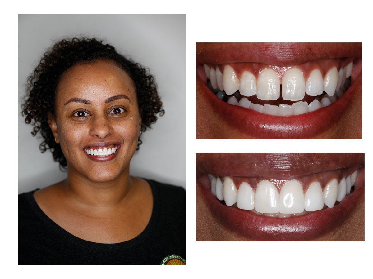 Cosmetic Composite Bonding 16