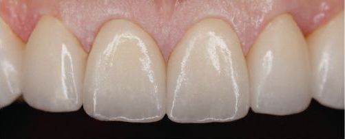 A close up of a woman 's smile with white teeth.