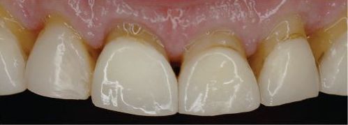 A close up of a person 's teeth with braces.