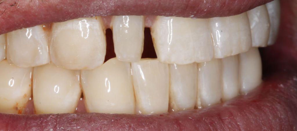 Dental Lateral Before