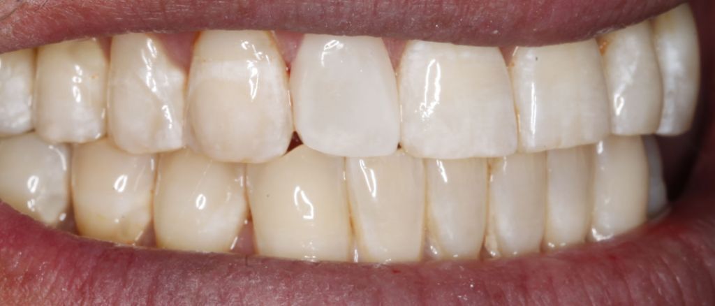 Dental Lateral After