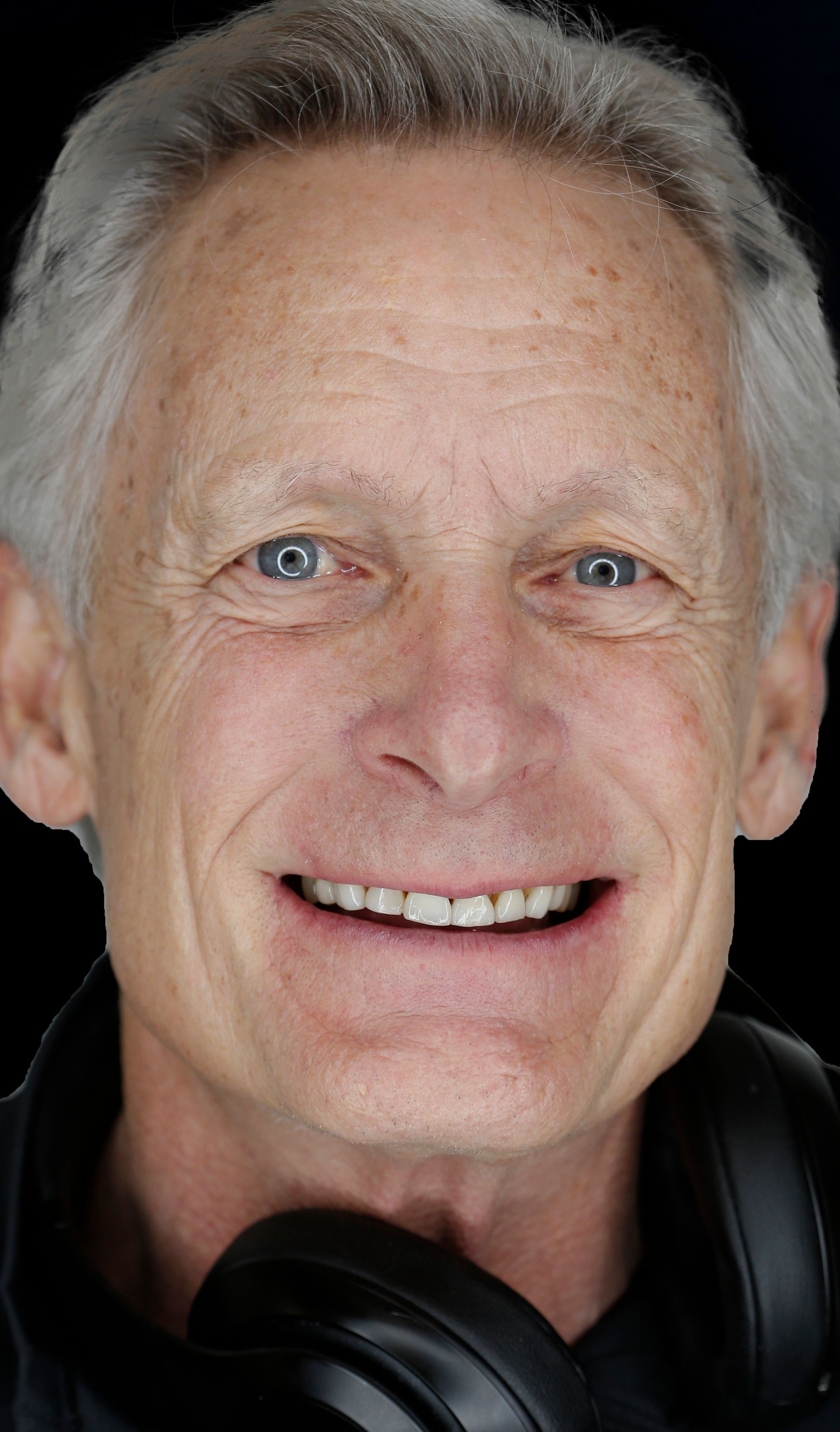 Shortened worn down teeth that need new porcelain restorations