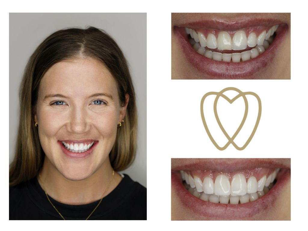 Cosmetic Composite Bonding 20