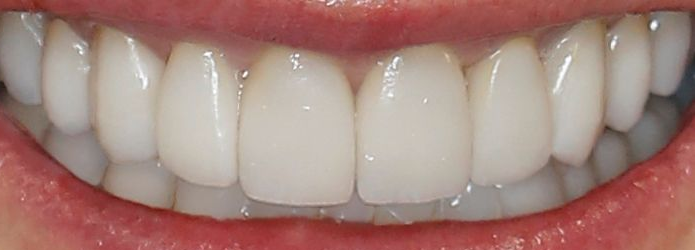 veneers