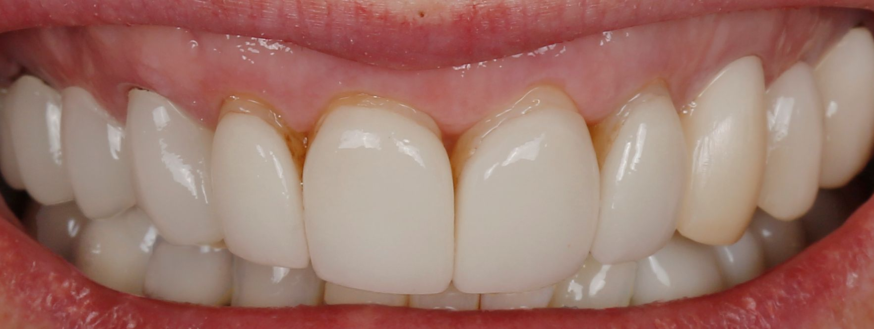 old dental bonding