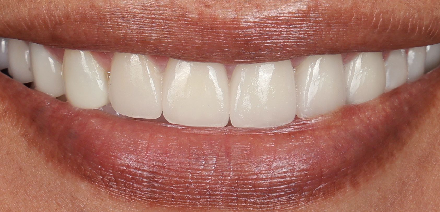 veneers