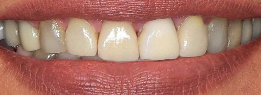old dental bonding
