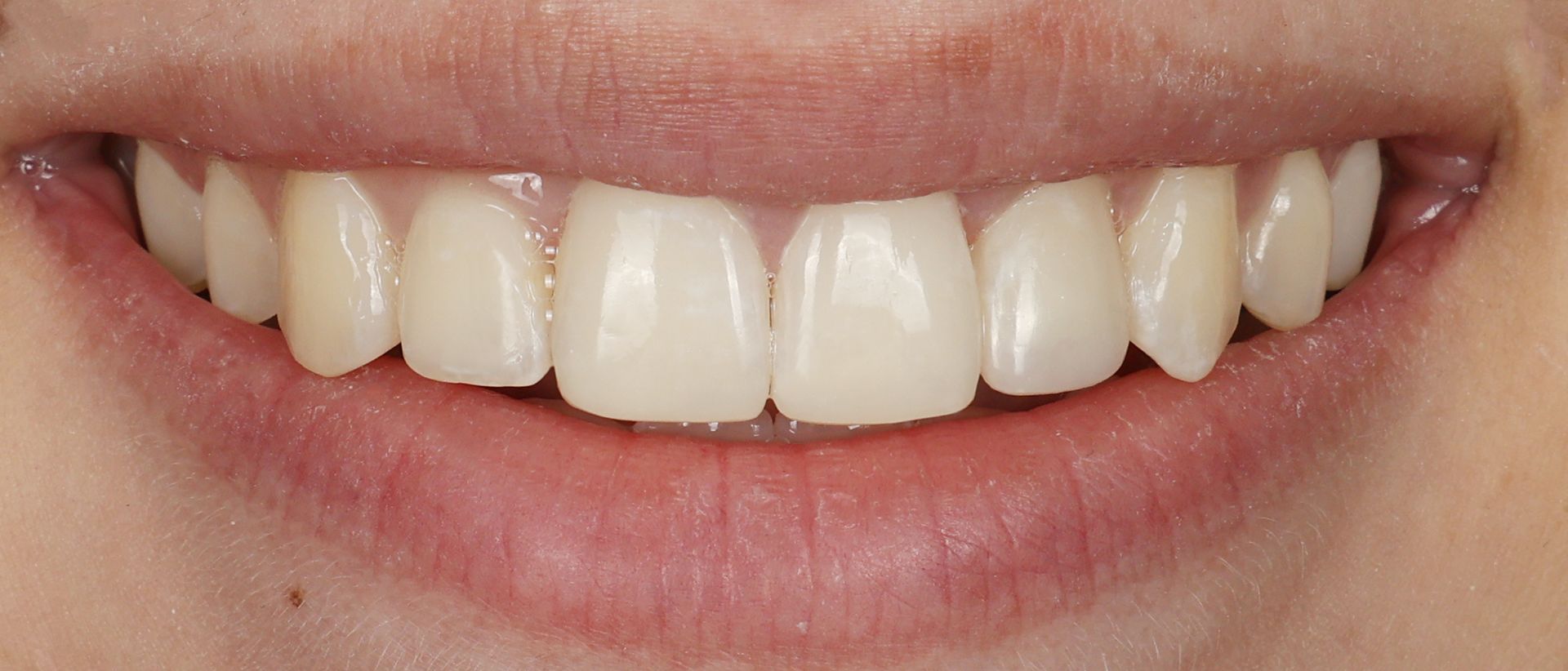 fix tooth length and white spots with dental bonding in denver